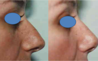 Rhinoplasty Female