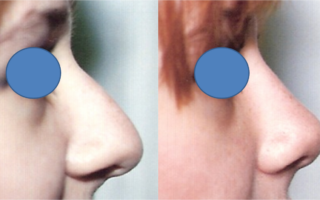 Rhinoplasty Female