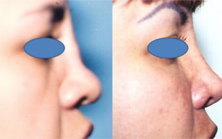 Rhinoplasty Female