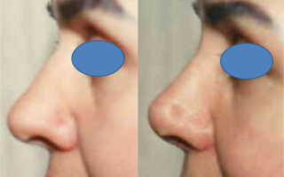 Rhinoplasty Female